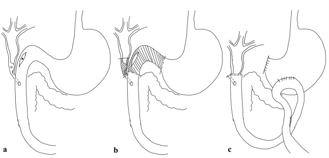 Choledochoduodenostomy combined with Billroth II procedure for extrahepatic biliary obstruction and duodenal perforation in a cat.