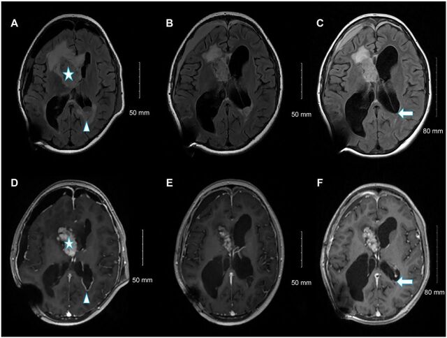 Sporadic subependymal giant cell astrocytoma with somatic <i>TSC2</i> mutation: A case report.
