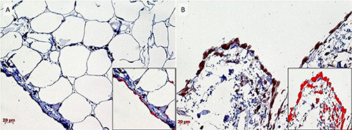 Pleural mesothelioma from fluoro-edenite exposure: PACAP and PAC1 receptor. A preliminary report.