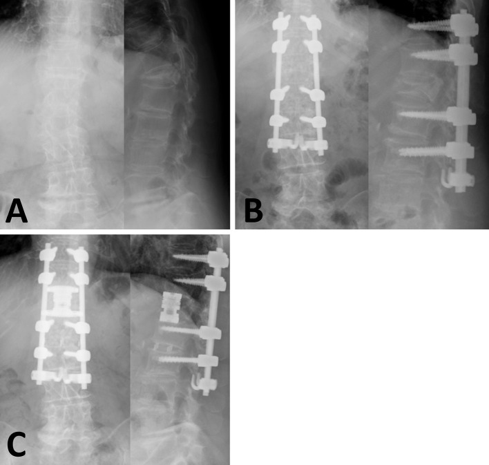 Indirect Decompression in Vertebral Reconstruction for Osteoporotic Vertebral Fractures with Neurological Symptoms: A Preliminary Case Series.