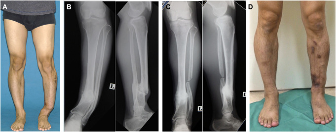 Management of open fracture and related complications: the Japanese way.