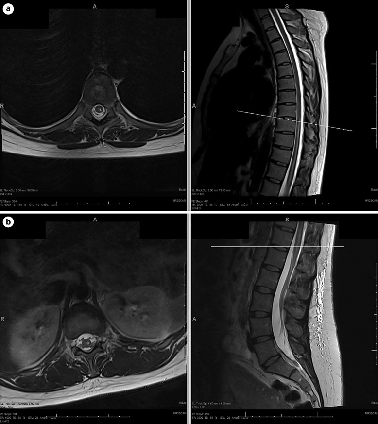 Unilateral Anterior Spinal Artery Syndrome following Spinal Anesthesia for Cesarian Section: A Case Report.