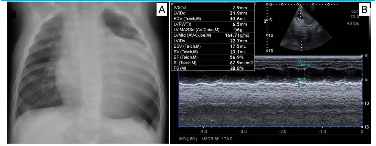 Incidental diagnosis of cardiac fibroma in an infant with acute viral bronchiolitis.
