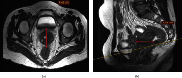Primary Dysgerminoma of the Uterine Cervix: A Rare Case Report.