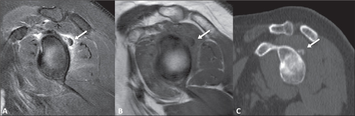 Imaging findings of acute calcific periarthritis, with emphasis on magnetic resonance imaging: pictorial essay.