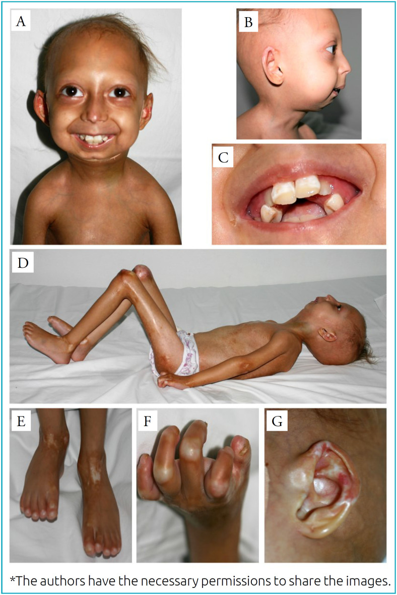 A rare LMNA missense mutation causing a severe phenotype of mandibuloacral dysplasia type A: a case report.