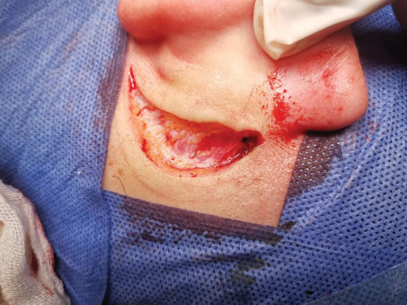 Pediatric Myringoplasty using the Periosteum: An Institutional Overview.
