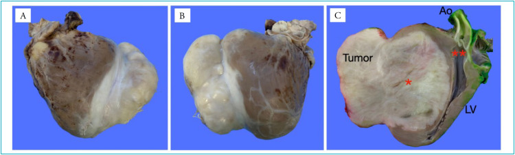 Incidental diagnosis of cardiac fibroma in an infant with acute viral bronchiolitis.