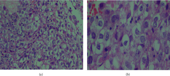 Primary Dysgerminoma of the Uterine Cervix: A Rare Case Report.