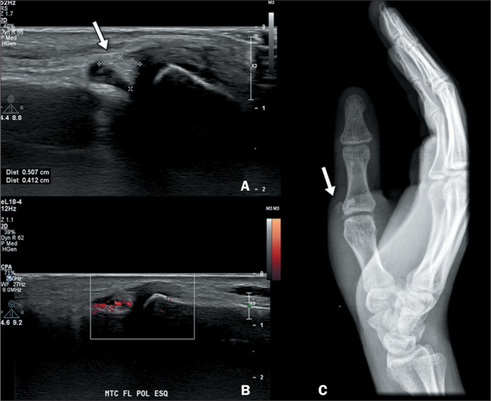 Imaging findings of acute calcific periarthritis, with emphasis on magnetic resonance imaging: pictorial essay.