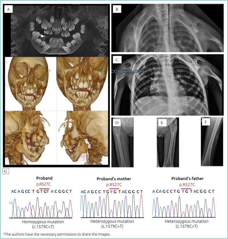 A rare LMNA missense mutation causing a severe phenotype of mandibuloacral dysplasia type A: a case report.