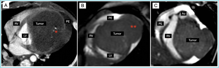 Incidental diagnosis of cardiac fibroma in an infant with acute viral bronchiolitis.