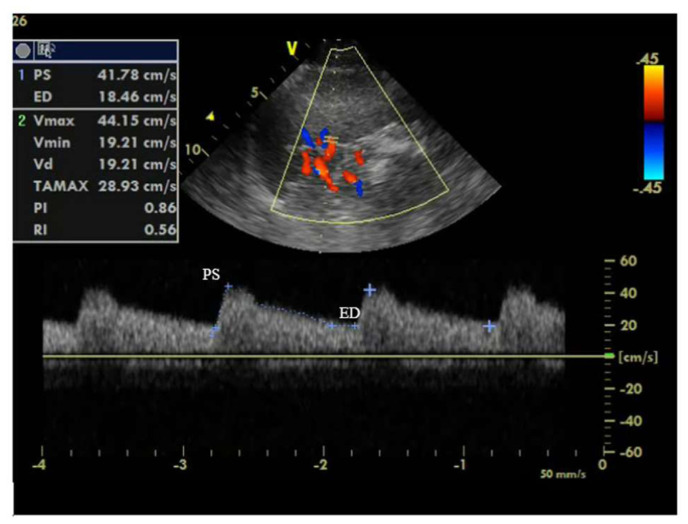 Abdominal Congestion as a Predictor of Worsening Renal Function in Patients With Acute Decompensated Heart Failure.