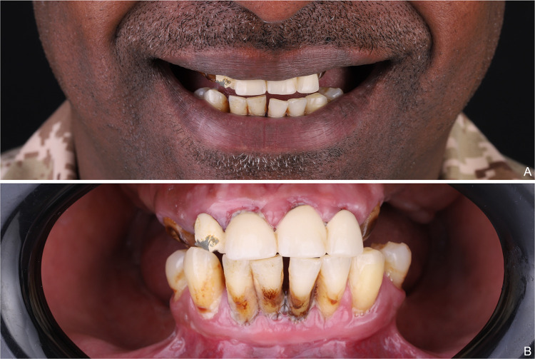 A Fully Guided Sequential Template Immediate Loading Protocol for Dual-Arch Implant Surgery.