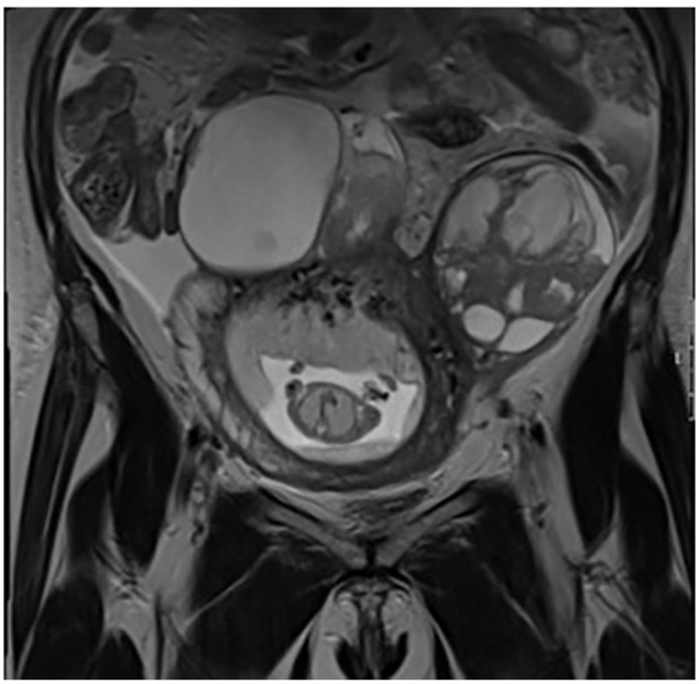 First Reported Histologically and Molecularly Confirmed Bilateral High-Grade Serous Ovarian Adenocarcinoma Metastasized to Placental Decidua of the Membranes.