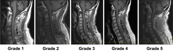 Primary Results of Our Protocol for Standardization of Perioperative Antiplatelet Agent Management on the Incidence of Epidural Hematoma and Thrombotic Complications in Posterior Cervical Surgery: A Prospective Cohort Study.