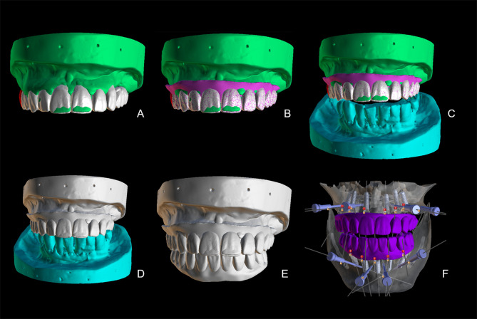 A Fully Guided Sequential Template Immediate Loading Protocol for Dual-Arch Implant Surgery.