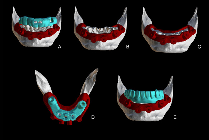 A Fully Guided Sequential Template Immediate Loading Protocol for Dual-Arch Implant Surgery.