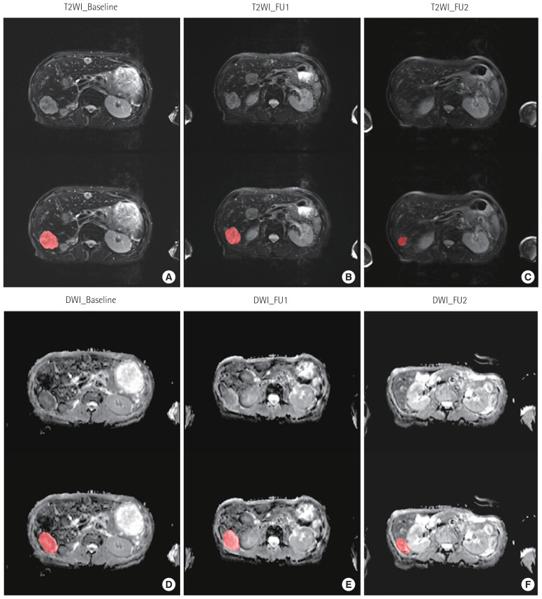 Radiomics and machine learning analysis of liver magnetic resonance imaging for prediction and early detection of tumor response in colorectal liver metastases.