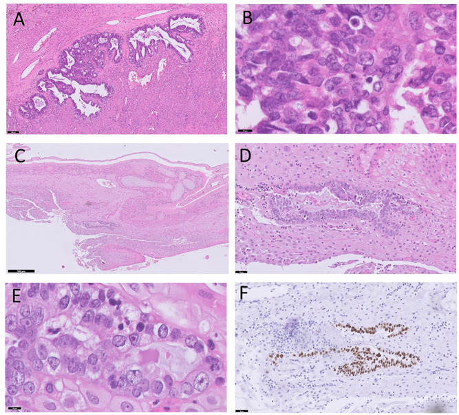 First Reported Histologically and Molecularly Confirmed Bilateral High-Grade Serous Ovarian Adenocarcinoma Metastasized to Placental Decidua of the Membranes.