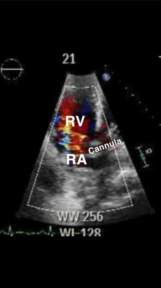 Veno-venous extracorporeal membrane oxygenation (VV ECMO) cannula malposition identified with point-of-care ultrasound.