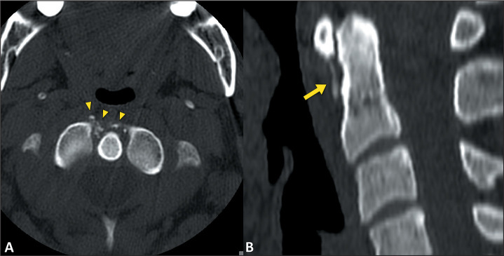 Imaging findings of acute calcific periarthritis, with emphasis on magnetic resonance imaging: pictorial essay.