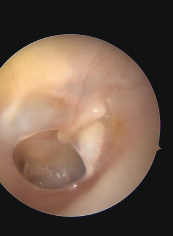 Pediatric Myringoplasty using the Periosteum: An Institutional Overview.