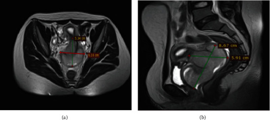 Primary Dysgerminoma of the Uterine Cervix: A Rare Case Report.