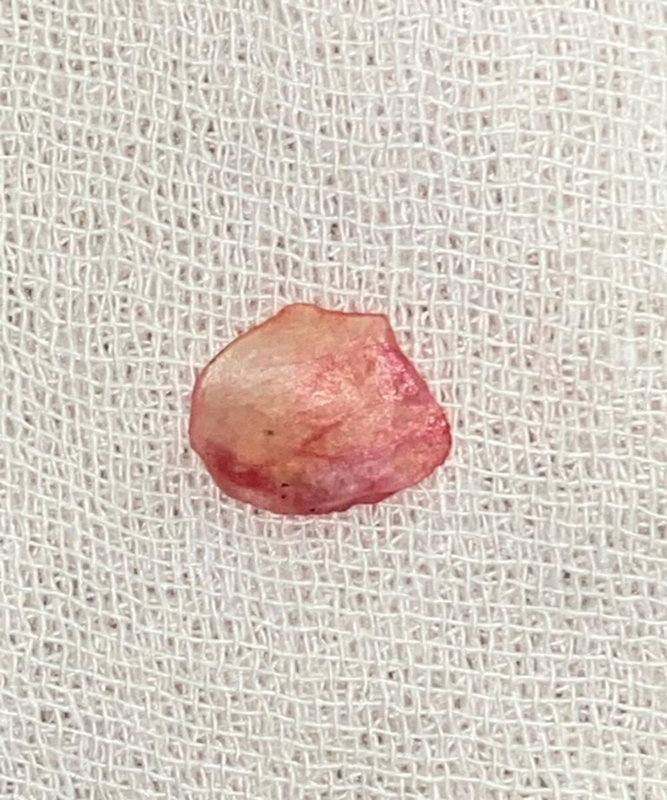Pediatric Myringoplasty using the Periosteum: An Institutional Overview.