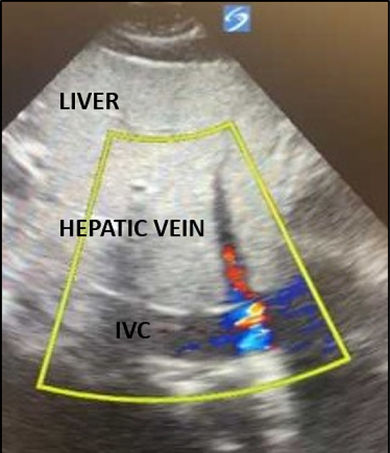 Veno-venous extracorporeal membrane oxygenation (VV ECMO) cannula malposition identified with point-of-care ultrasound.