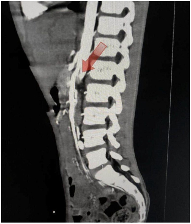 Superior Mesenteric Artery Syndrome in an 11-Year-Old Boy: A Case Report.
