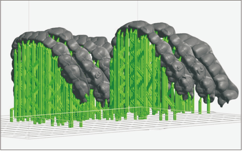 Accuracy of orthodontic movements with 3D printed aligners: A prospective observational pilot study.