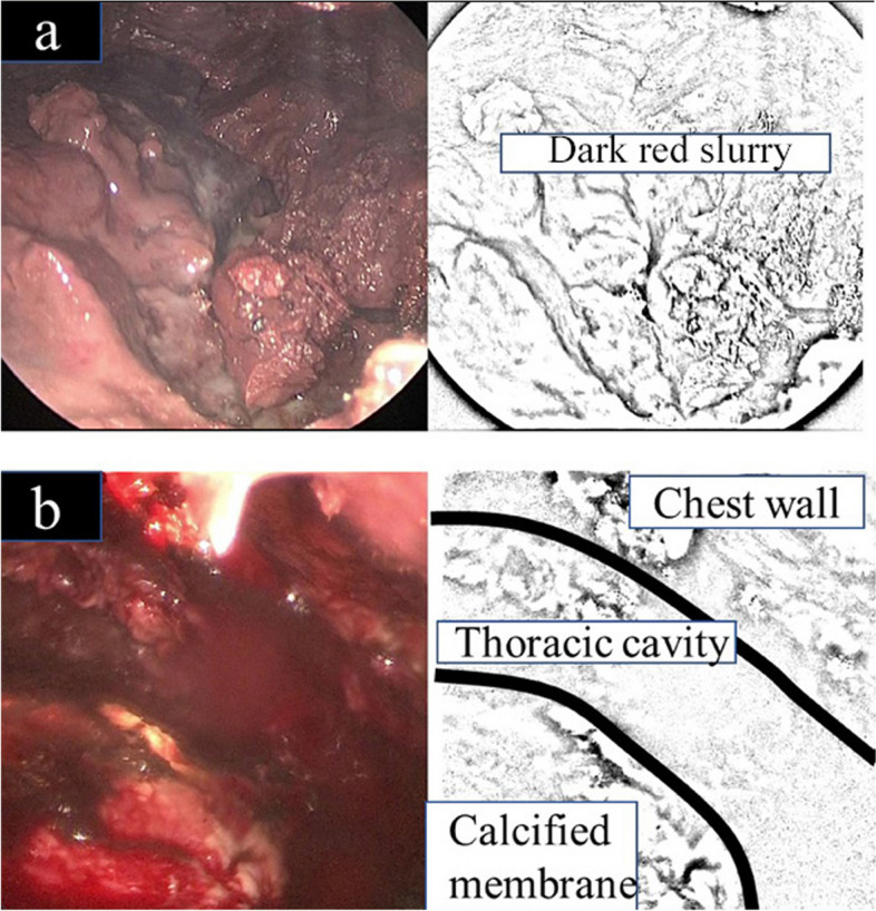 Successful treatment with fenestration followed by daily decortication and negative-pressure wound therapy for acute exacerbation of chronic empyema: a case report.