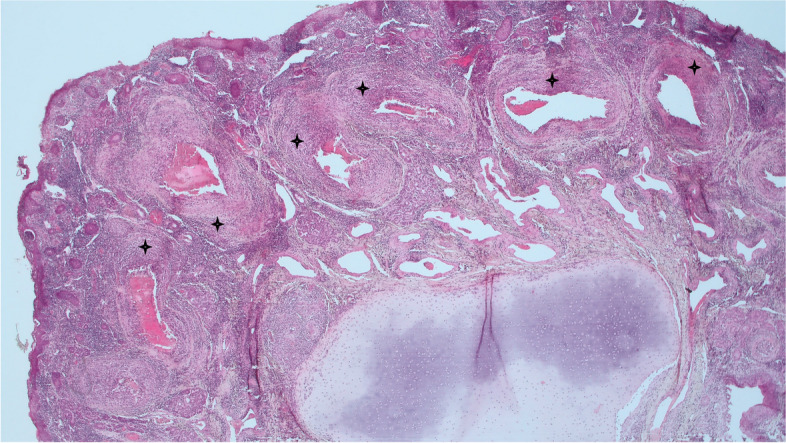 First reported case in an Irish flock of MCF- like systemic necrotizing vasculitis in sheep associated with ovine herpesvirus 2.