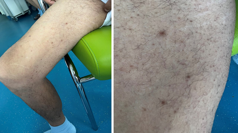 Characteristic Skin Eruptions with a Distinct Histological Pattern Allow Early Diagnosis of Vitamin C Deficiency.