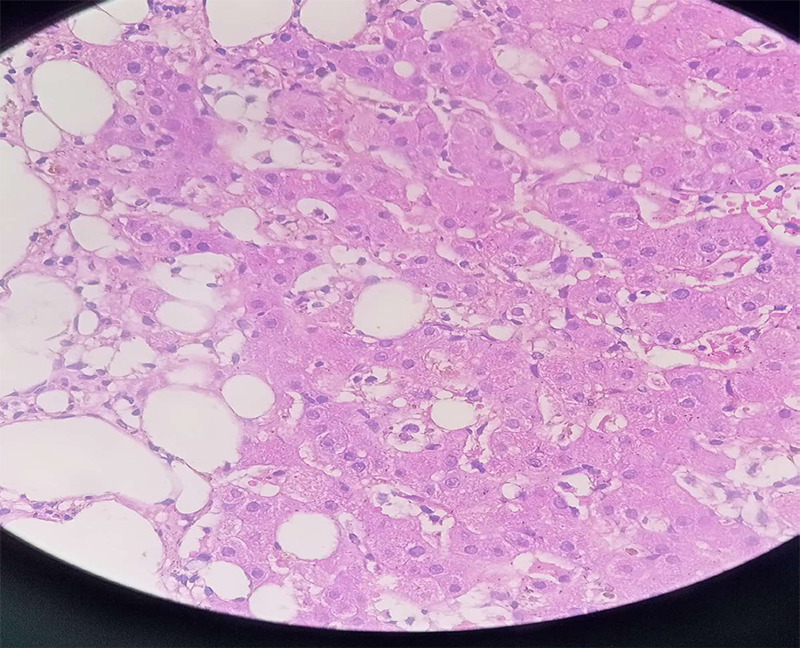Diagnosis of Hemophagocytic Lymphohistiocytosis in Pyrexia of Unknown Origin: A Case Report.