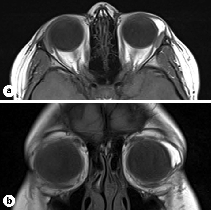 Epibulbar Complex Choristoma Containing Bone: A Case Report and Closer Look at Classifications.