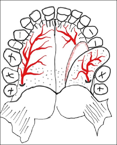 Systematic review of minimally-invasive reconstructive options for oral cavity defects.