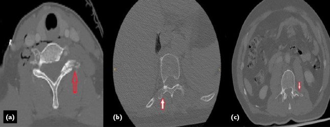 Clinical analysis of transverse process fractures: A comprehensive study on patient characteristics, management, and outcomes in trauma care.