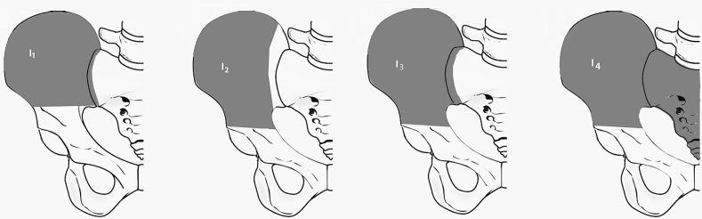 Outcomes of ilium and iliosacral Ewing's sarcoma resection reconstructed with tibial strut allograft.