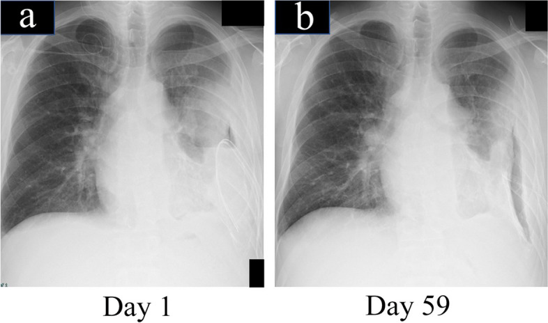 Successful treatment with fenestration followed by daily decortication and negative-pressure wound therapy for acute exacerbation of chronic empyema: a case report.