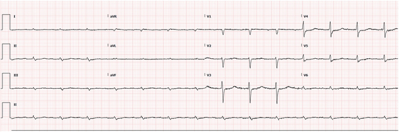 PCI vs. CABG in left main with multi-vessel coronary artery disease and diabetes: Case report.