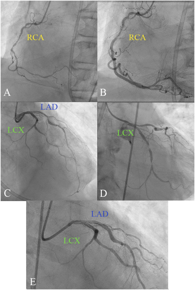 PCI vs. CABG in left main with multi-vessel coronary artery disease and diabetes: Case report.