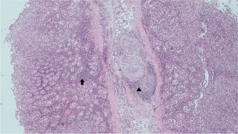 First reported case in an Irish flock of MCF- like systemic necrotizing vasculitis in sheep associated with ovine herpesvirus 2.