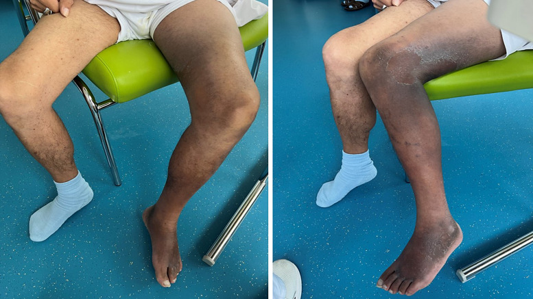 Characteristic Skin Eruptions with a Distinct Histological Pattern Allow Early Diagnosis of Vitamin C Deficiency.