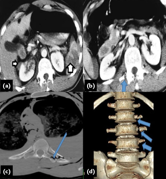 Clinical analysis of transverse process fractures: A comprehensive study on patient characteristics, management, and outcomes in trauma care.