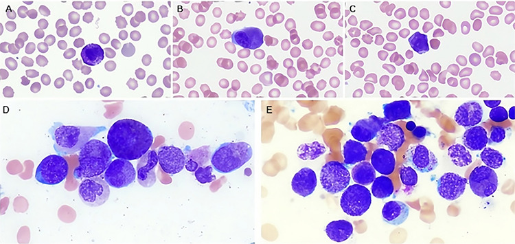 Acute Promyelocytic Leukemia with Basophilic Differentiation: A Rare Variant