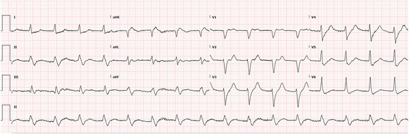 PCI vs. CABG in left main with multi-vessel coronary artery disease and diabetes: Case report.