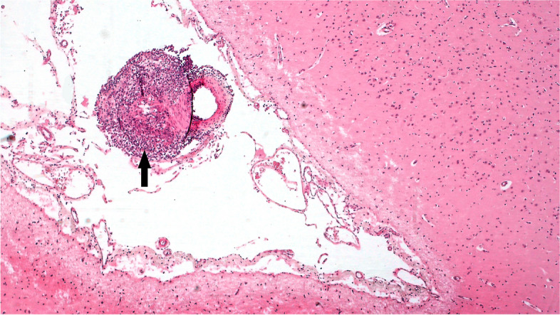 First reported case in an Irish flock of MCF- like systemic necrotizing vasculitis in sheep associated with ovine herpesvirus 2.