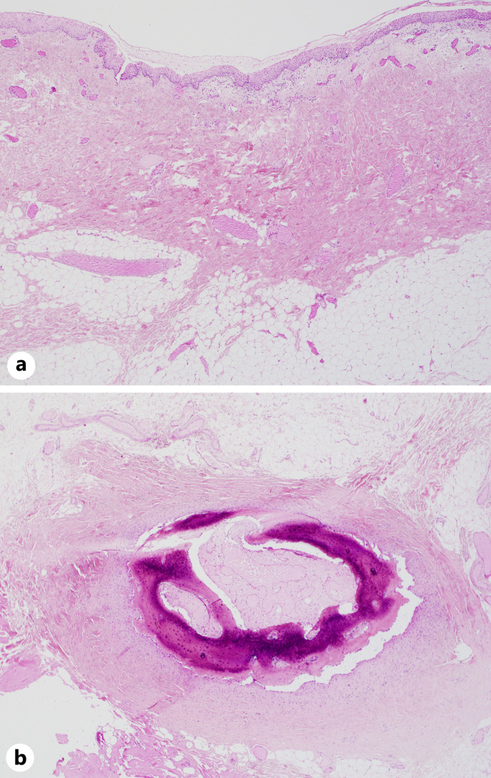 Epibulbar Complex Choristoma Containing Bone: A Case Report and Closer Look at Classifications.